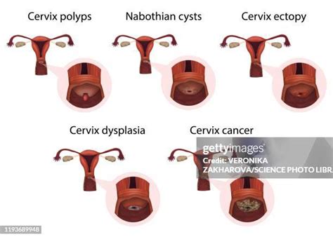 19 Cervical Polyps Stock Photos High Res Pictures And Images Getty