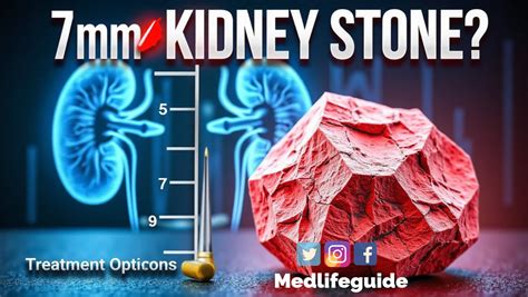 Discover Effective Treatments for 7mm Kidney Stone Relief