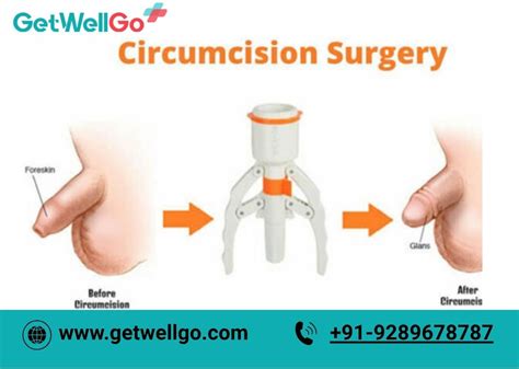 Adult Circumcision Procedure Care Recovery Results And More