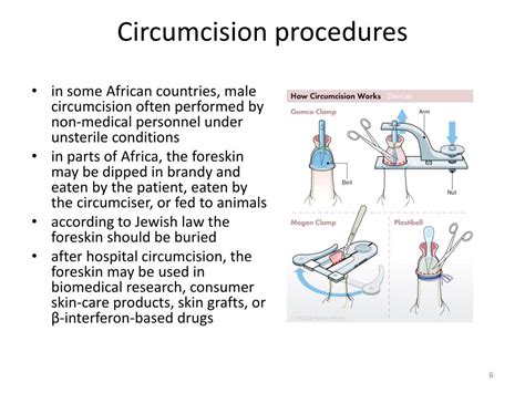 Different Types Of Circumcision Procedures At Will Hannah Blog