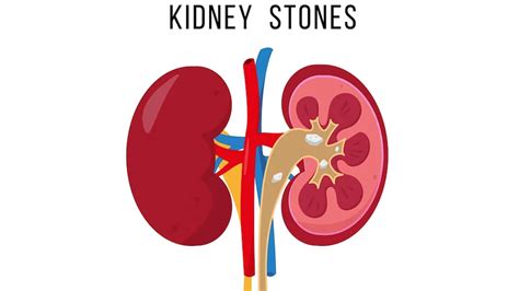 Do Kidney Stones Cause Constipation?