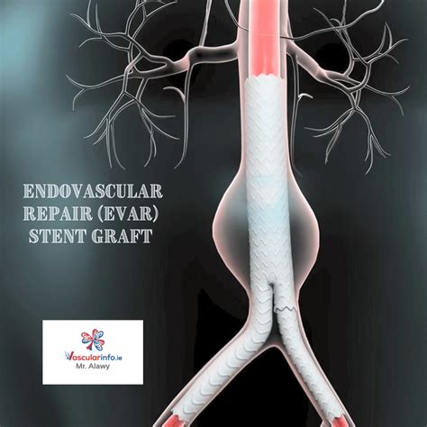 Endovascular Surgery Breakthroughs Explained