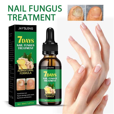 Fingernail Fungus Best Treatment At John Spiker Blog