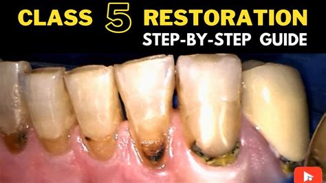 How Complete Dental Restorations Improve Chewing Speaking And Everyday Life Atlanta Dental Spa How Complete Dental Restorations Improve Chewing Speaking And Everyday Life Atlanta Dental Spa