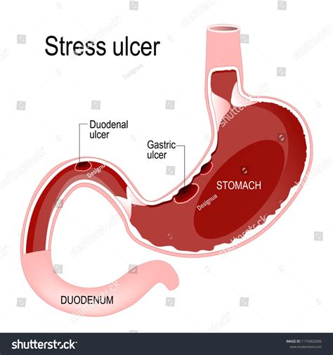 Peptic Ulcer Gastric Duodenal Stress Ulcers Ppts Pptx Peptic Ulcer Gastric Duodenal Stress Ulcers Ppts Pptx
