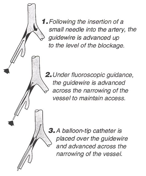 PTA Medical Abbreviation: Unlocking Its Meaning and Importance