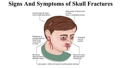 Recovery Exercises For Skull Fractures: Quick, Safe Rehab Tips