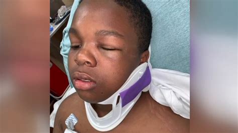 Scotland County Woman Talks About School Fight That Left Her Son Badly Hurt Scotland County Woman Talks About School Fight That Left Her Son Badly Hurt
