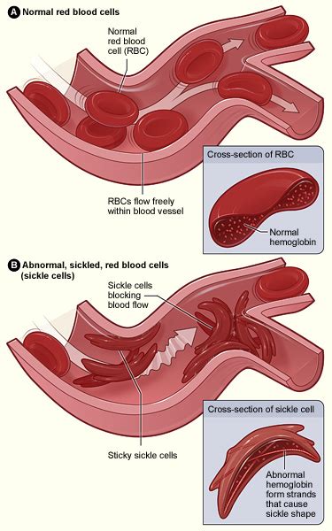 Sickle Cell Disease Wikipedia
