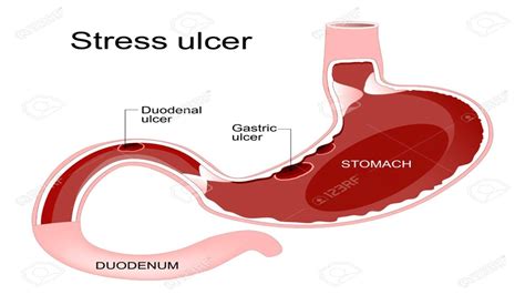 Stress Ulcer Causes, Prophylaxis, Symptoms, Diagnosis,, 56% Off Stress Ulcer Causes, Prophylaxis, Symptoms, Diagnosis,, 56% Off