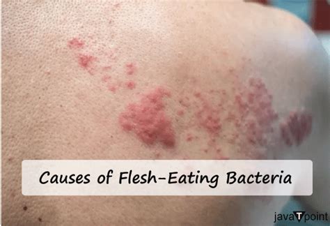 Symptoms Of Flesh Eating Bacteria Singapore Toddler Infected By Flesh
