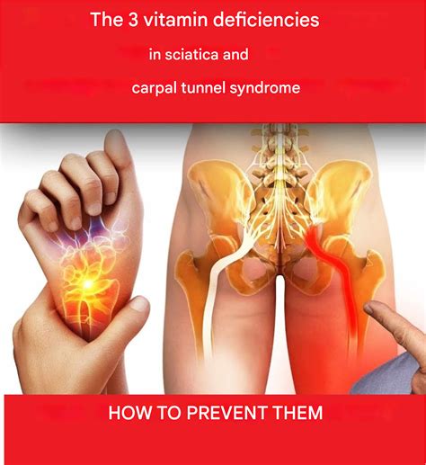 The 3 Vitamin Deficiencies In Sciatica And Carpal Tunnel Syndrome The 3 Vitamin Deficiencies In Sciatica And Carpal Tunnel Syndrome