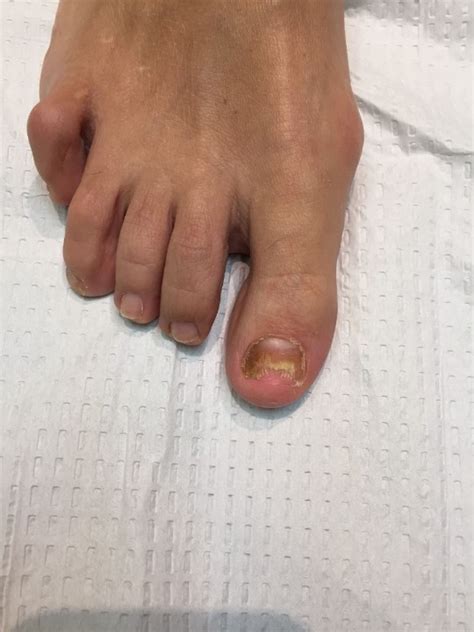 Top Rated Laser For Fungal Nails In Edgemont