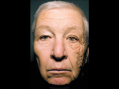 Trucker Accumulates Skin Damage On Left Side Of His Face After 28 Years On The Road Cbs News