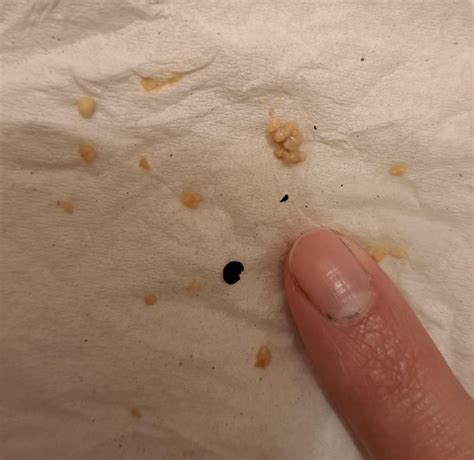 Why Aren T They Called Tonsil Turds Instead R Tonsilstones